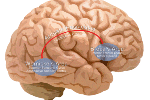 Aphasia